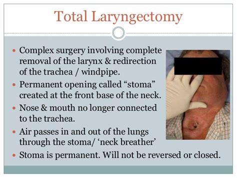 laryngectomy vula|Iba pa.